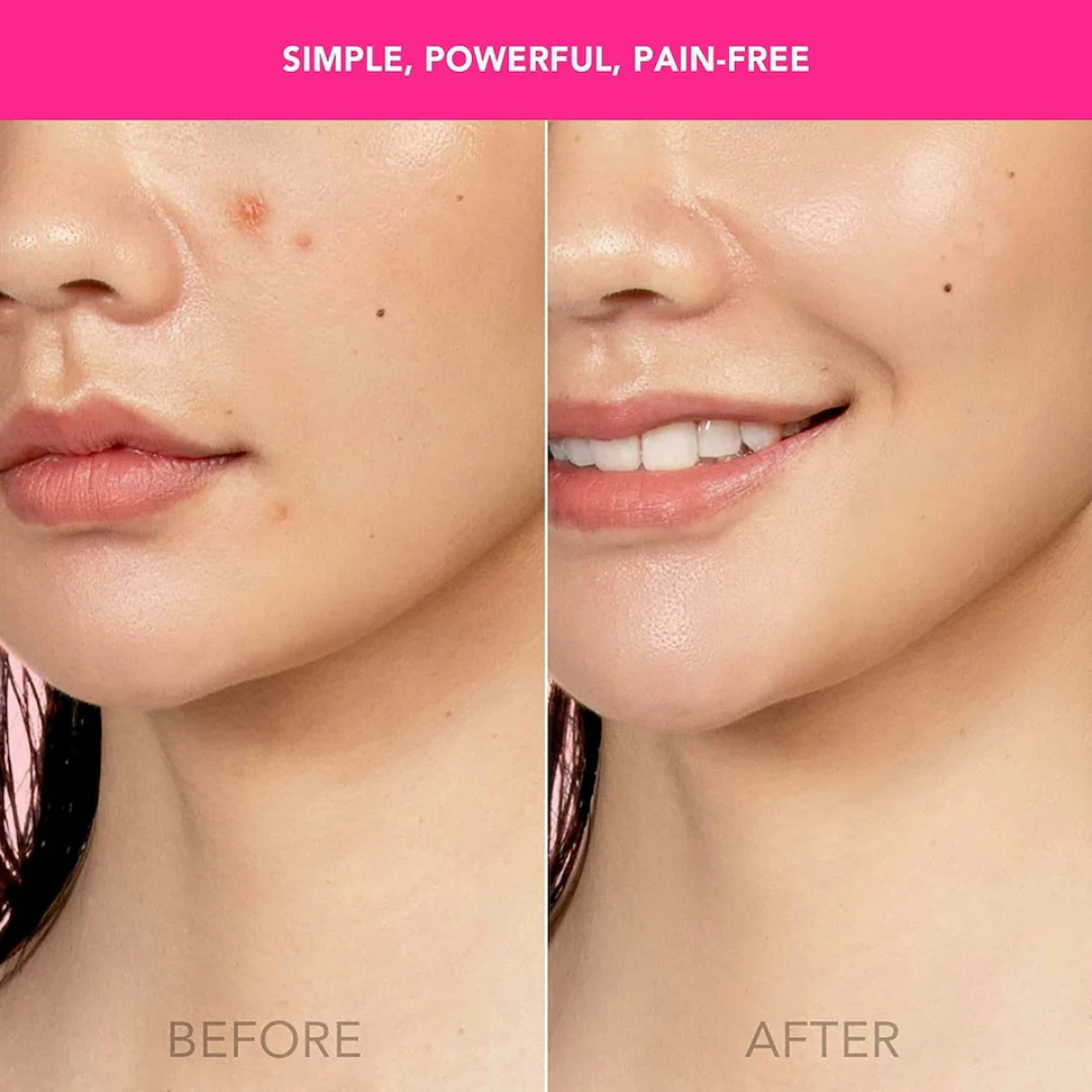 Foreo Espada Magenta - Acne Treatment Device - Image 3